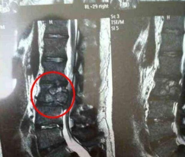 spinal tumor bilang sanhi ng pananakit ng likod