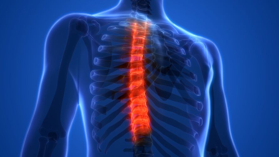 Osteochondrosis ng thoracic spine, na nailalarawan sa pamamagitan ng pagkasira ng mga intervertebral disc
