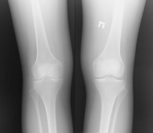 Ang radiograph ng kasukasuan ng tuhod