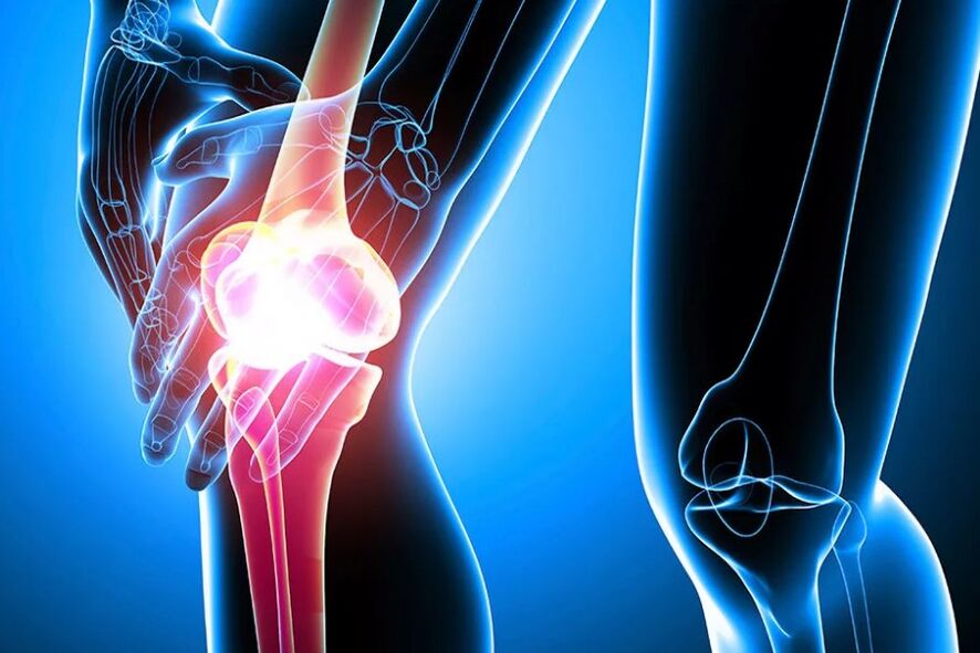 Arthrosis ng tuhod