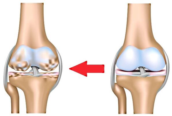 Malusog na pinagsamang at arthrosis