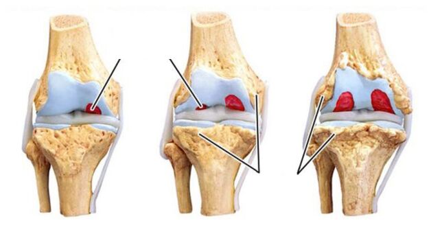 Mga komplikasyon ng arthrosis ng mga kasukasuan