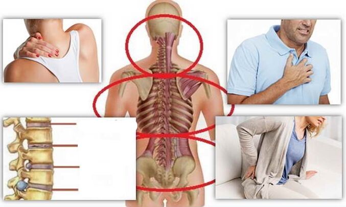 Mga lugar ng sakit para sa osteochondrosis