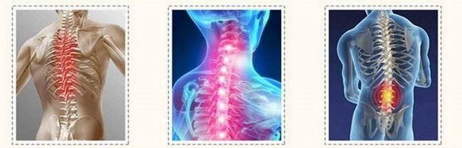 Osteochondrosis spinal lesyon