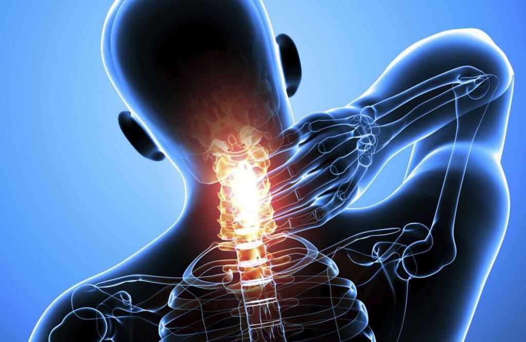 Osteochondrosis ng cervical spine