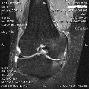 Osteoarthritis ng kasukasuan ng tuhod sa MRI