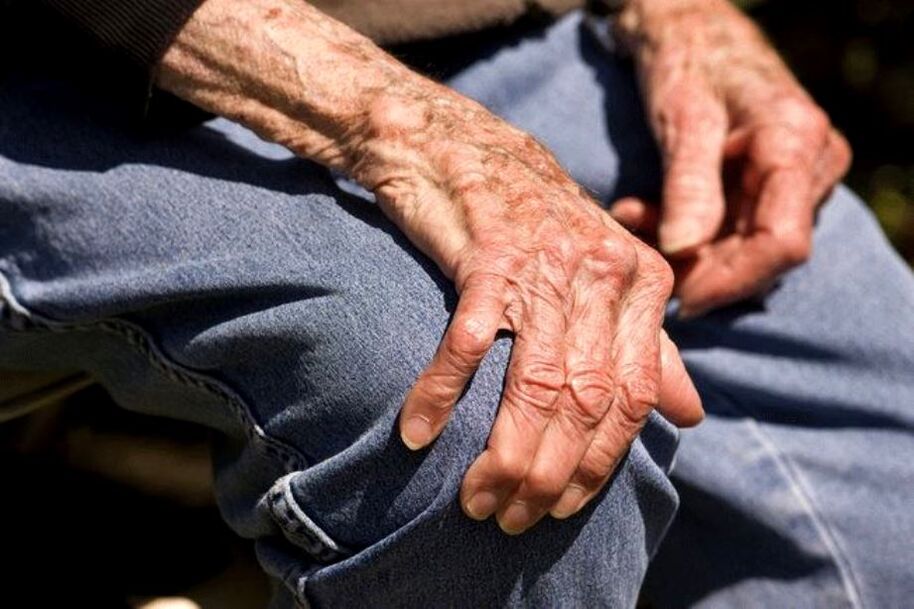 Ang Arthrosis ay isang sakit na nauugnay sa edad na nangyayari sa mga matatandang tao
