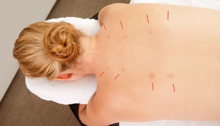 Acupuncture para sa thoracic osteochondrosis, na may maraming mga pakinabang