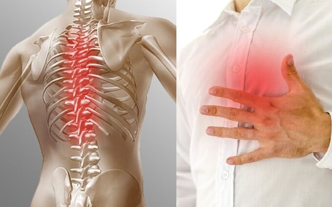 Ang thoracic osteochondrosis ay ipinahayag sa pamamagitan ng sakit at isang pakiramdam ng paninikip sa dibdib